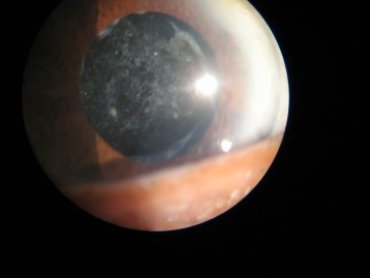 Corneal Abscess